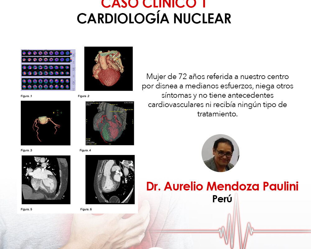 caso clínico, cardiología nuclear