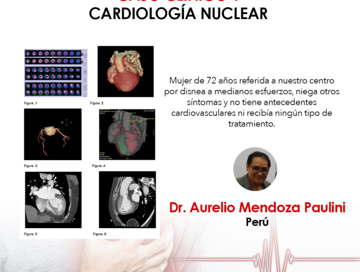 caso clínico, cardiología nuclear