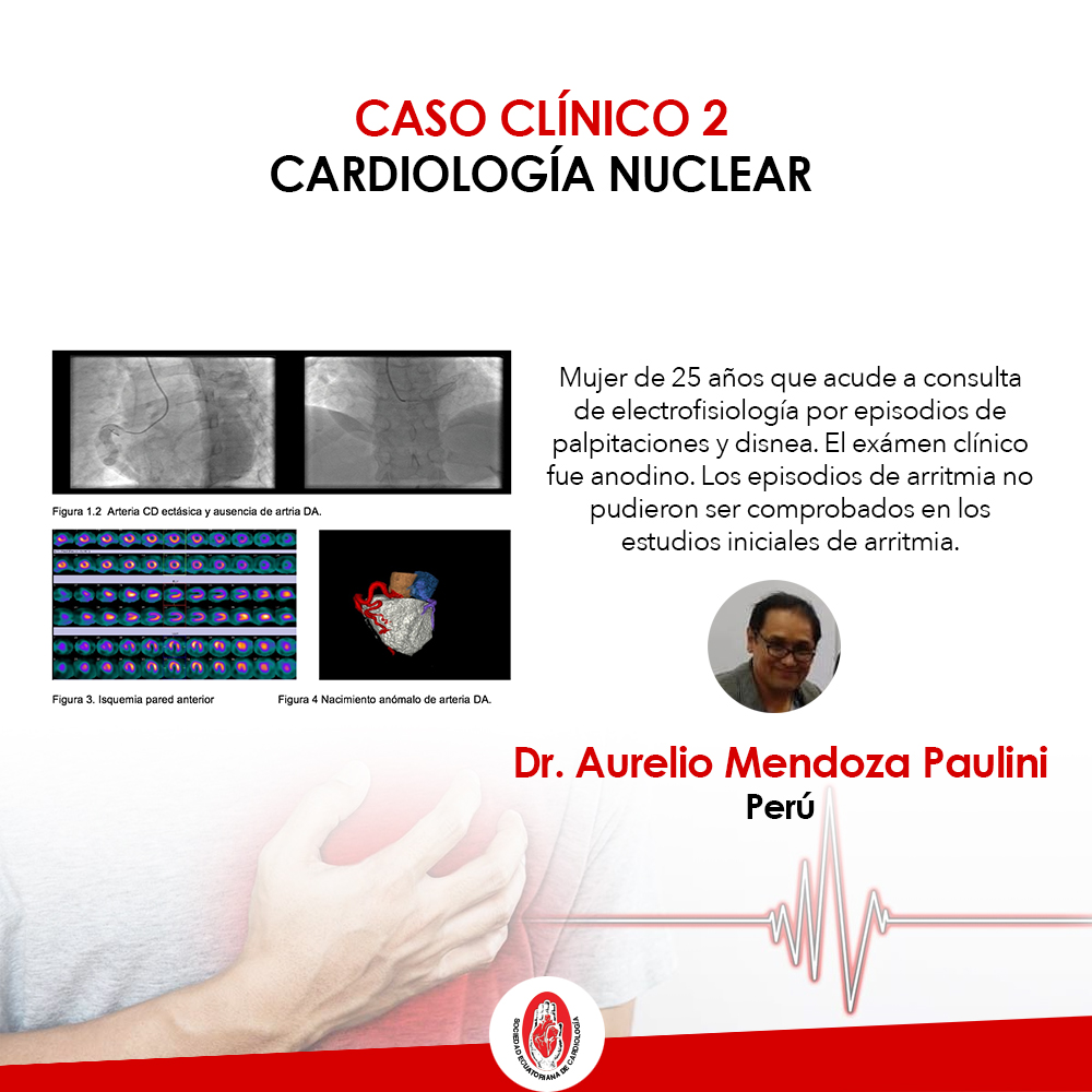 caso clínico, cardiología nuclear